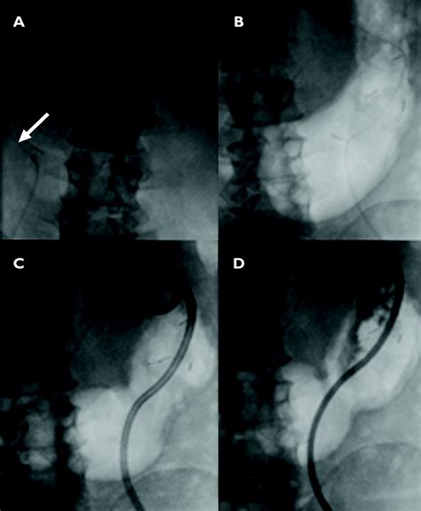 pegogram|Radiologic Percutaneous Gastrostomy: Review of Potential ...